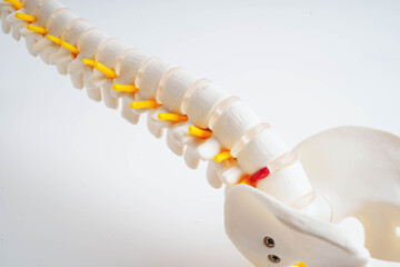Spinal nerve and bone, Lumbar spine displaced herniated disc fragment, Model for treatment medical in the orthopedic department.