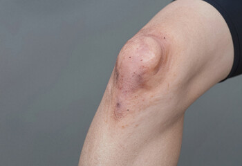 Close-up of a human knee exhibiting pronounced swelling and minor abrasions, indicative of an injury or physical trauma.