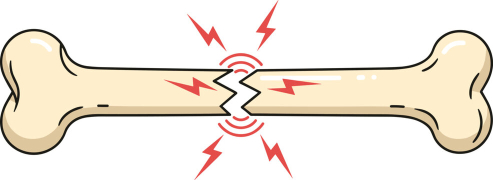 Broken bone with jagged fracture and pain symbols, cartoon injury icon &ndash; flat vector illustration