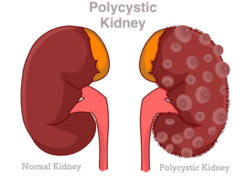 Polycystic kidney disease. PKD, PCKD or polycystic kidney syndrome is a genetic disorder that causes many fluid filled cysts to grow in kidneys. Urinary system. Illustration vector