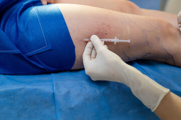 Vein injection for leg vein treatment and improved vascular health.