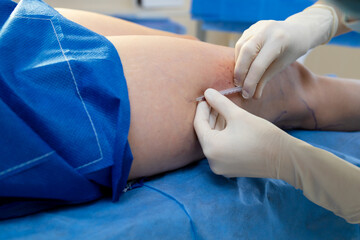 Obraz premium Doctor injecting veins to restore vascular function in legs.