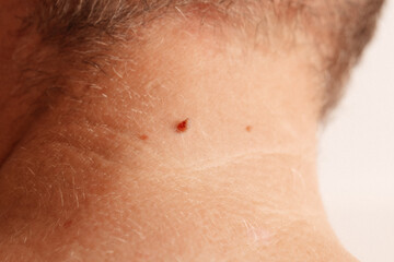 Fototapeta premium Small Cherry Angioma on Human Skin Close Up