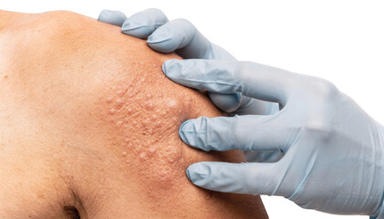 Naklejka premium Closeup of a clinicians hands gently examining an armpit with visible velvety skin texture against a white background highlighting skin thickening detection.