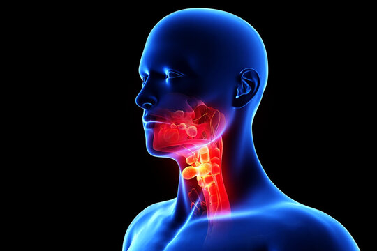 Throat cancer tumor Human neck anatomy with inflamed lymph nodes and throat image