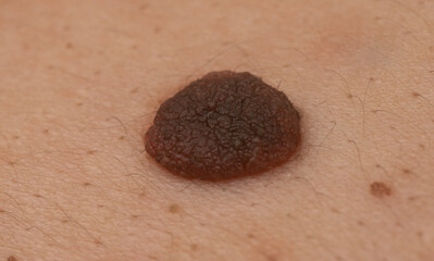 Raised mole close up on human skin with detailed nevus texture. Macro of pigmented skin mole for...