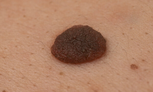 Raised mole close up on human skin with detailed nevus texture. Macro of pigmented skin mole for dermatology. Dark brown mole on body skin for melanoma awareness and early detection theme.