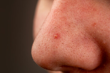 Fototapeta premium Acne pimple on nose close up with visible pores and skin texture detail. Macro facial skin showing red inflamed blemish with clogged pore and sebum. Concept with acne zit and comedone on nose.