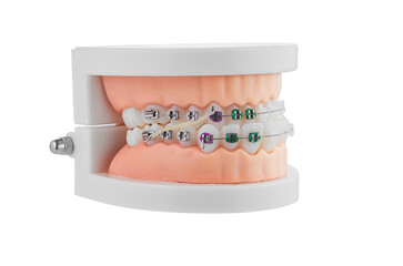 Dental Orthodontic Model With Braces Demonstrating Brackets, Wire, and Alignment for Study