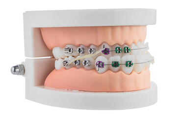 Dental Orthodontic Model With Braces Demonstrating Brackets, Wire, and Alignment for Study