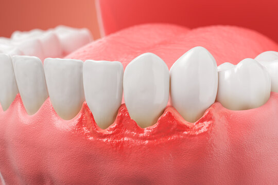 3d illustration of teeth and oral health showing gum disease and inflammation.