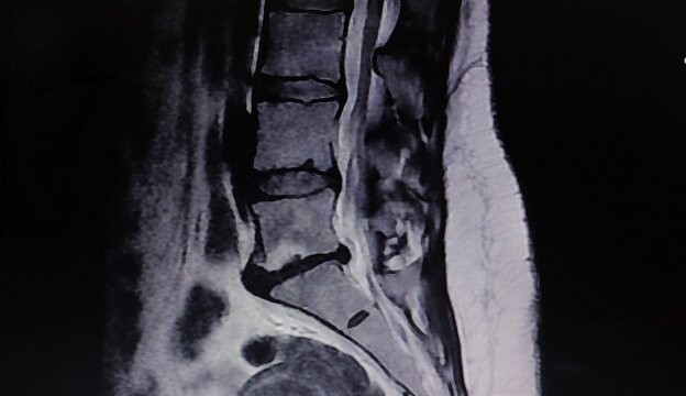 Axial CT scan showing bipolar disc herniation with anterior and posterior extension in the lumbar sacral spine, ideal for medical education, radiology reference, diagnosis, and healthcare content.