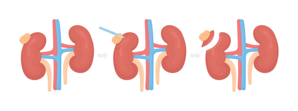 Vector illustration showing kidney tumor removal in three stages. Medical concept of renal surgery, neoplasm treatment, urology procedure, healthcare, anatomy infographic, isolated on white background