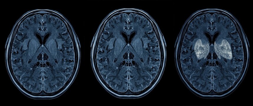 Axial MRI of the brain to evaluate glioblastoma and metastasis: isodensity mass with ill-defined margins and edema in right frontal lobe