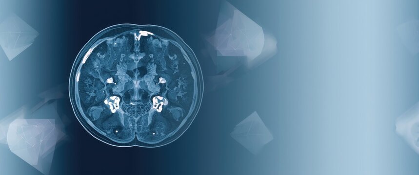 Deviated nasal Septum detected in Maxillary sinus CT scan