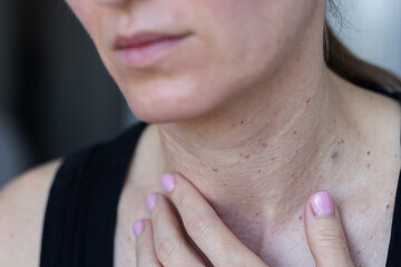 Fototapeta premium Female neck with problem skin after biorevitalization procedure. Closeup. Beauty injections.