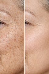 Fototapeta premium Skin aging vs after collagen boost result on mature woman cheek, comparison closeup of wrinkle and dark spot reduction, smooth hydrated glow texture improvement side by side view