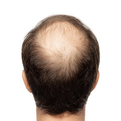 Obraz premium Male Hair Loss Back View, Thinning Scalp and Receding Hairline Isolated