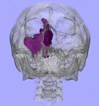 3D CT scan of the paranasal sinuses showing sinus cavities, nasal septum, and facial bones with findings suggestive of sinusitis, nasal polyps, or mass lesions for radiology and ENT evaluation