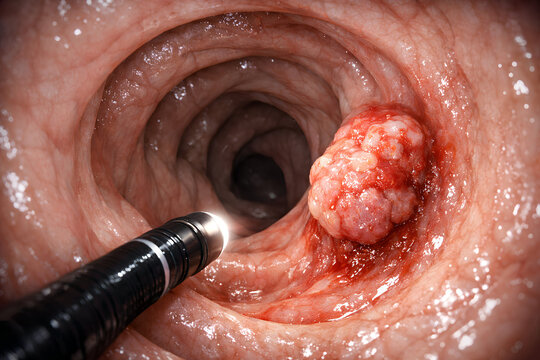 Colonoscopy procedure examining colorectal cancer cells inside the colon with a medical device and intense lighting from a specific viewpoint