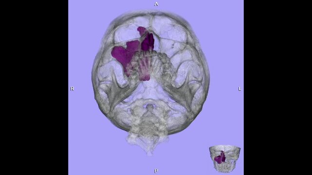 3D CT scan of the paranasal sinuses showing sinus cavities, nasal septum, and facial bones with findings suggestive of sinusitis, nasal polyps, or mass lesions for radiology and ENT evaluation