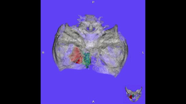 3D CT scan of the paranasal sinuses showing sinus cavities, nasal septum, and facial bones with findings suggestive of sinusitis, nasal polyps, or mass lesions for radiology and ENT evaluation