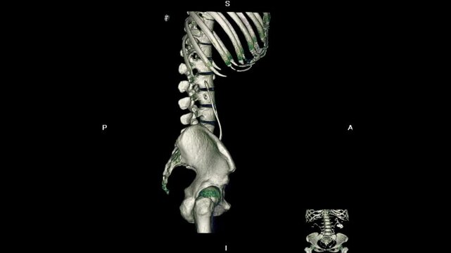 3D CT scan visualization of the urinary system showing kidneys, ureters, bladder, and ureteral stent placement for management of large kidney stones, used in diagnostic imaging and urology procedures