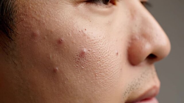 Extreme close-up of human skin texture with visible pores, imperfections, and blemishes