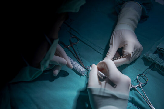 Surgeon preparing Physician Modified Endovascular Graft (PMEG) using an aortic stent graft in operating room.