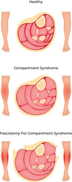 Compartment Syndrome Pathology Symptoms and Fasciotomy Treatment
