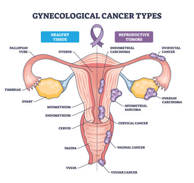 Vaginal vs cervical vs uterine cancer illustrated to compare tumor locations across the female reproductive system, key structures, uterus, cervix, vagina. Outline diagram