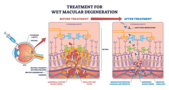 Wet macular degeneration treatment, retina cross-section shows before-after anti-VEGF effect, key objects, syringe, retina, leaking vessels. Outline diagram
