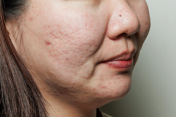 Obraz premium Real young woman's face with acne scars, blemishes and oily skin texture, dermatology and skincare concept.