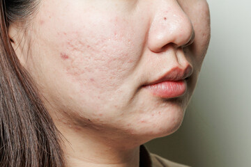 Real young woman's face with acne scars, blemishes and oily skin texture, dermatology and skincare...