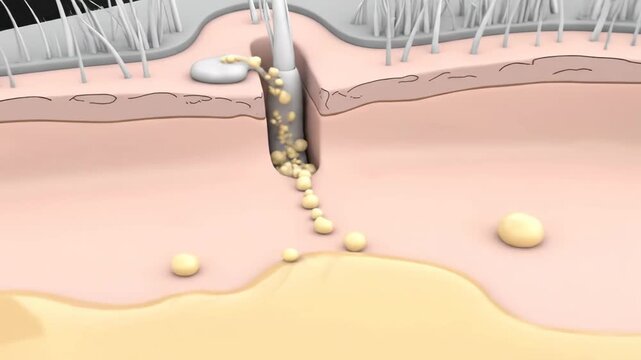 3D animation showing a sebaceous gland producing sebum in a hair follicle, illustrating oily skin and oil secretion.