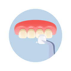 Veneer installation vector isolated on white background.