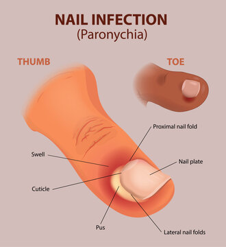 Nail Fold Infection Anatomy Illustration diagram