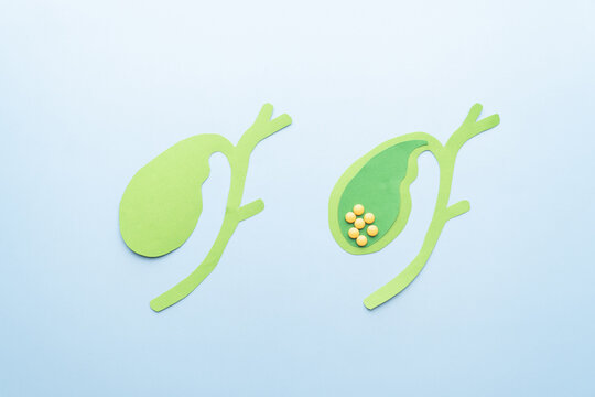 Gallbladder with gallstones (cholelithiasis) anatomy made from paper on blue background. Gallstone blocks the flow of bile through your biliary system causing cholecystitis, pancreatitis, cholangitis.