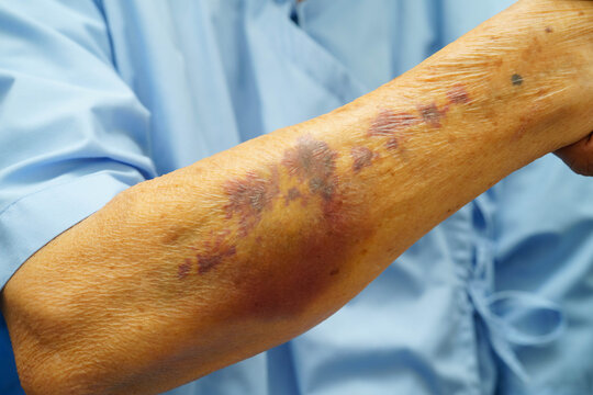 Ecchymosis, elderly bleeding on her arm after taking aspirin.