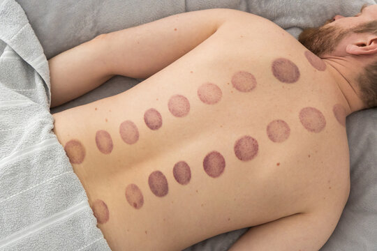 The marks on the man's back are large, deep purple, circular marks ecchymosis caused by cupping therapy, an ancient form of alternative medicine used for pain relief and muscle relaxation