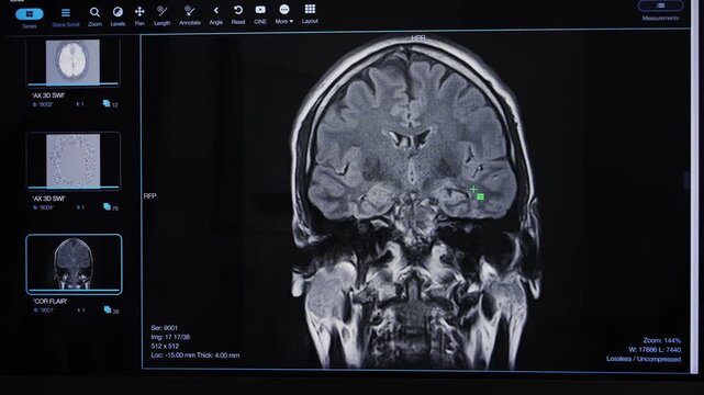 Detailed brain scans made with advanced MRI software displayed on the computer screen. High quality 4k footage
