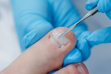 Close-up of ingrown toenail podiatrist treatment by gloved hands using medical tools, shape form...