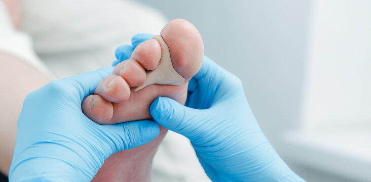 Podiatrist treating foot with toe separator in medical clinic