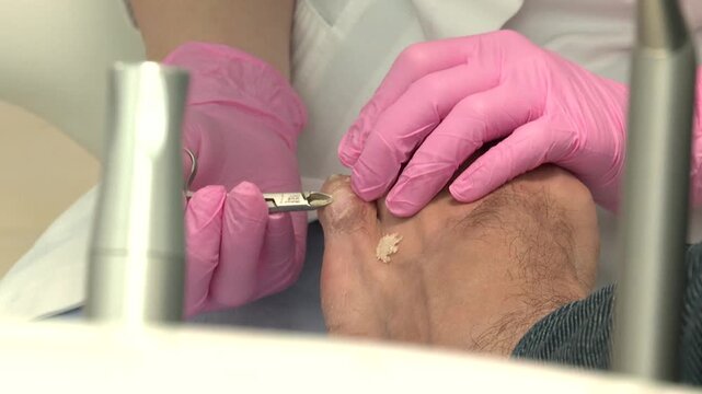 Close up of a podiatrist in pink gloves carefully removing dead skin from a patient's toe wound using scissors during a medical foot care procedure.

