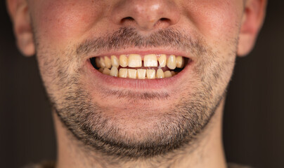 Obraz premium Un avant blanchiment dentaire avec les dents jaunes. 