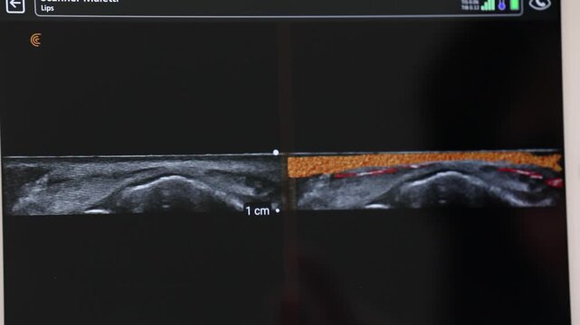 Close-up of a medical ultrasound monitor screen displaying a real-time scan of skin tissue layers with color imaging for diagnostic analysis in a modern healthcare clinic.

