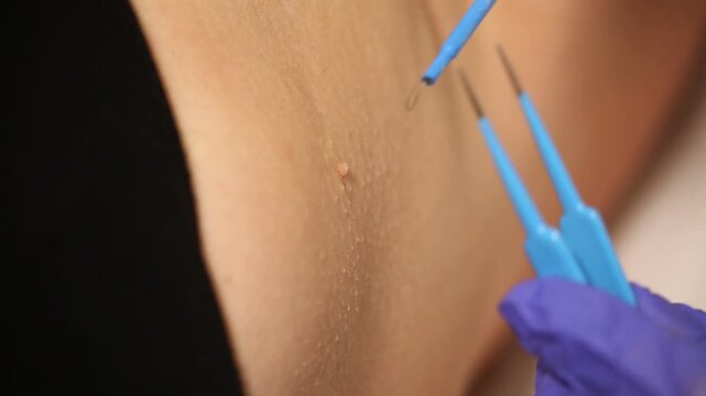 Close-up of a doctor removing a skin papilloma from a female armpit using a laser device and forceps in a clinic.

