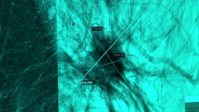 Medical diagnostic screen displaying an ultrasound scan of a mass. Digital crosshairs measure the dimensions of a potential tumor or cyst in millimeters during a radiology examination.

