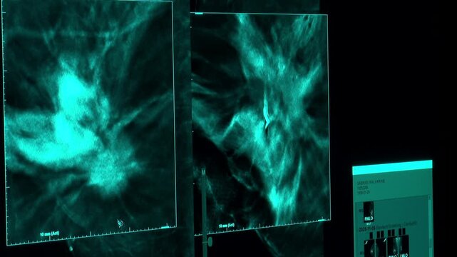 Medical screen showing digital mammography scan. Detailed X-ray images of breast tissue are analyzed for abnormalities or tumors during a routine cancer screening procedure in a modern clinic.

