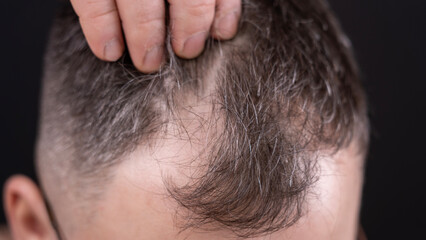 A middle-aged man has gray hair and is experiencing hair loss. He is concerned about the condition of his scalp and hair. High quality photo